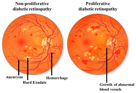 Nonproliferative Vs Proliferative Retinopathy