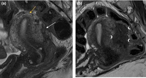 MRI findings in deep infiltrating endometriosis: A pictorial essay ...