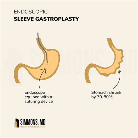 Endoscopic Sleeve Gastroplasty