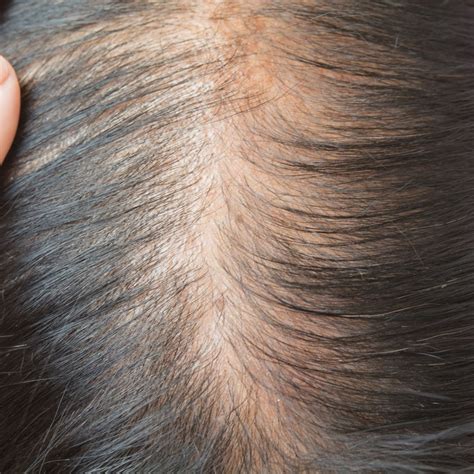 Expert Hair and Scalp Health Treatments in Manhattan - Sadick Dermatology