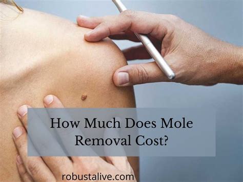 How Much Does Mole Removal Cost? - Robustalive