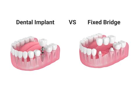 What Is A Dental Fixed Bridge at Brad Krahn blog