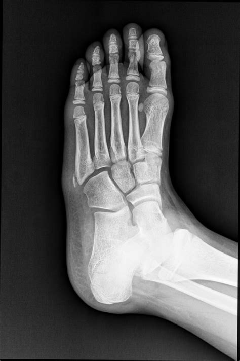 Avulsion Fracture 5Th Metatarsal Xray at Jose Watson blog
