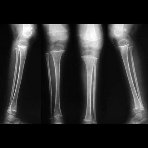Scurvy | Pediatric Radiology Reference Article | Pediatric Imaging | @pedsimaging