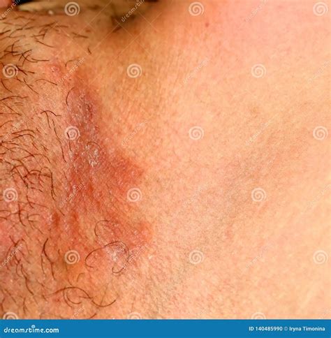 Hongos En La Ingle: Causas, Síntomas Y Tratamiento | Doctor Online