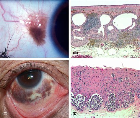 Primary Acquired Melanosis Treatment