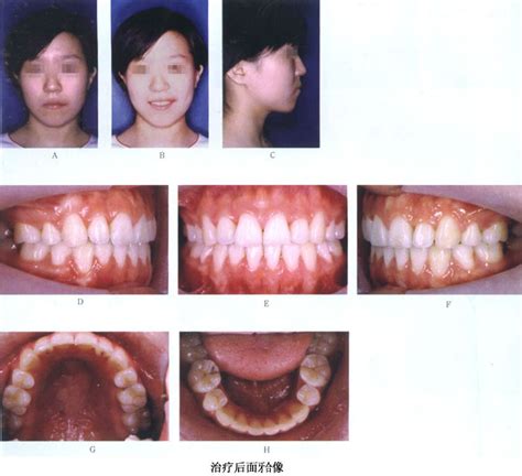 一个30岁女人关于牙齿矫正的一些经历 - 知乎