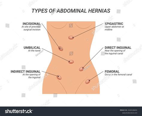 Types Abdominal Hernias Illustration On Isolated Stock Vector (Royalty Free) 2183126431 ...