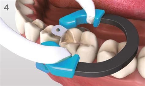 Palodent V3: Sectional Matrix System | Dentsply Sirona India