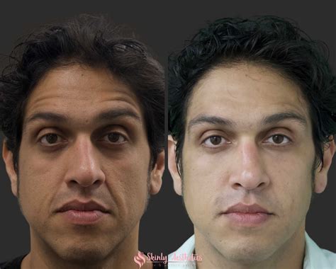 Laugh Lines / Nasolabial Folds – PMGLFP