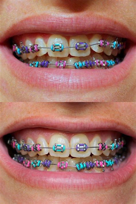 Braces Brackets Colors at Darlene Huth blog