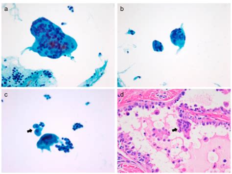 Atypical Histiocytoid Cells and Multinucleated Giant Cells in Fine ...