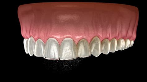 Invisalign Animation 的图像结果