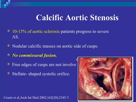 Echo assessment of Aortic valve disease, Dr Ferdous assistant registrar, Cardiology,Dhaka ...