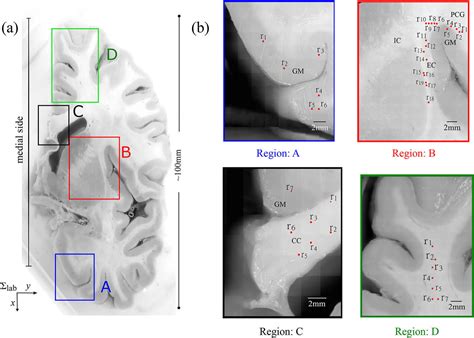 [原文] Application of Polarization Imaging Techniques in Brain Tumor Detection 偏振成像技术在脑肿瘤检测中的应用_lu ...