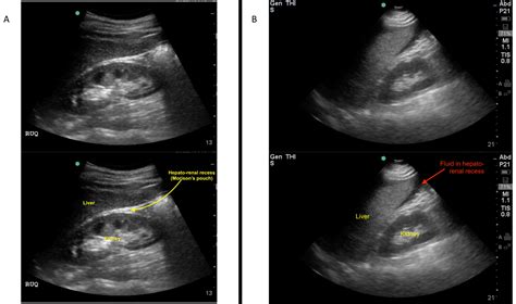 Focused Assessment with Sonography for Trauma (FAST) Exam: Image ...
