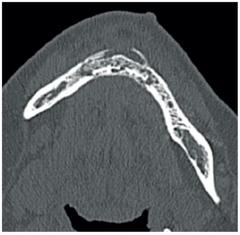 Medication-Related Osteonecrosis of the Mandible Treated with Marginal ...