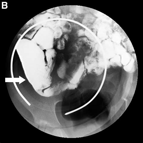 Meckel’s Diverticulum on Small-Bowel Follow-Through Series and ...