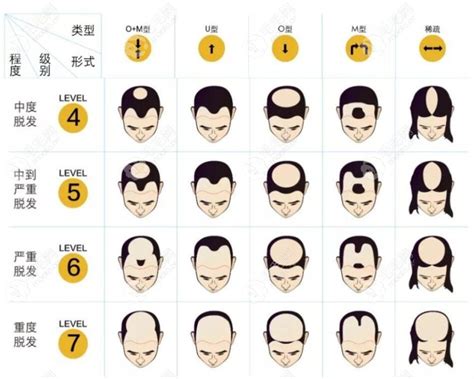 脱发1-7级程度图片，含男生/女生m型脱发等级判定及恢复方法 - 爱美容研社