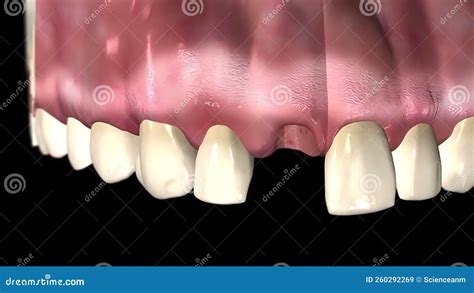 Image result for Tooth Extraction Side Profile