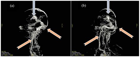Vein of Galen Malformation—Experience of the Last 13 Years in a ...