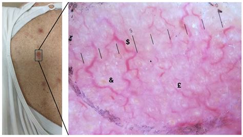 Dermatoscopic Patterns in Mycosis Fungoides: Observations from a Case ...