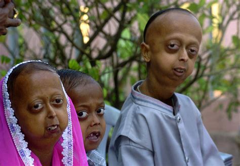 Rare Disease Day: Five of the rarest conditions in the world | IBTimes UK - Extremely Rare Diseases