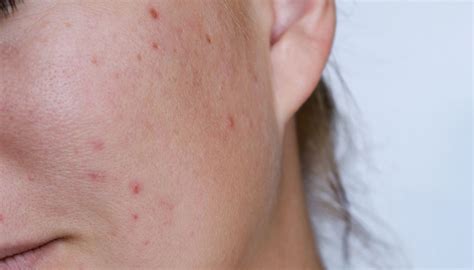 Chemical Peels for Acne Scars: How Many Treatments Do You Need? - Utah Facial Plastics