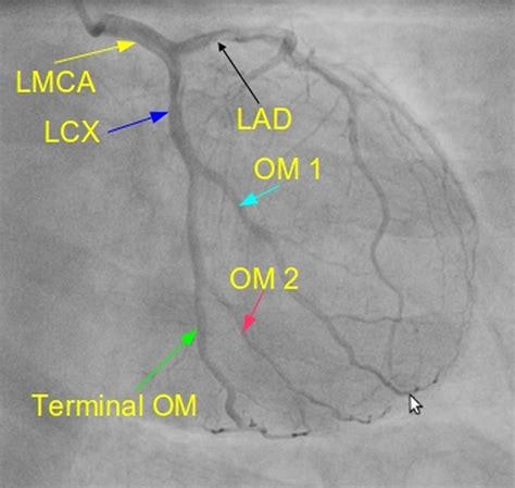 Circumflex Artery