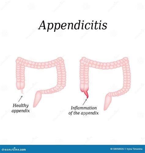 Image result for Appendix Inflammation