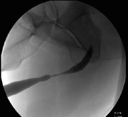 Most Common Mistakes in Training Residents: Retrograde Urethrography