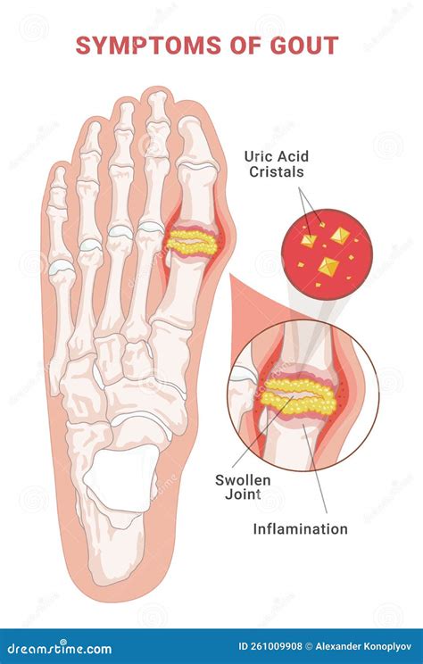 Symptoms of Gout Infographic Scheme Vector Flat Human Foot with ...