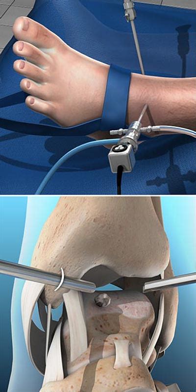 Arthroscopy of the Ankle | Central Coast Orthopedic Medical Group