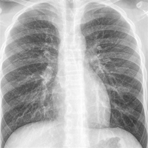 Healthy Chest X Ray Vs Pneumonia at Eric Mullins blog