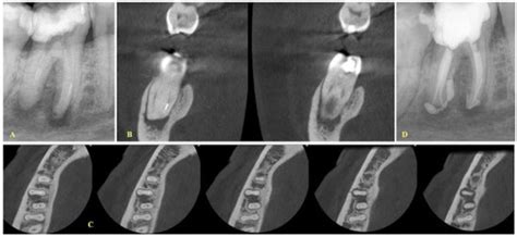 The Effect of Cone-Beam Computed Tomography (CBCT) Evaluation on ...