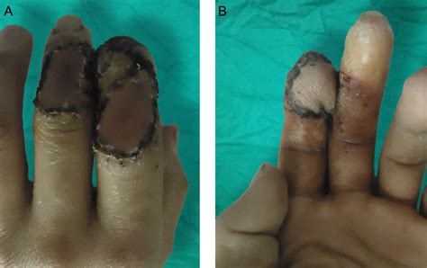 Treatment of fingertip avulsion injuries using two periposition ...