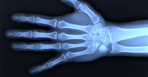 Radius Fracture 的图像结果