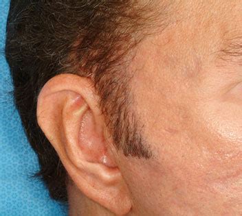 Beard, Moustache, Eyebrow, Facial Hair transplant cost in Ludhiana Punjab