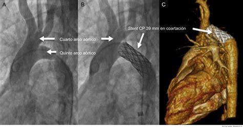 Coartación del quinto arco aórtico persistente con interrupción del ...