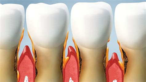 Image result for Gum Paste Pocketing