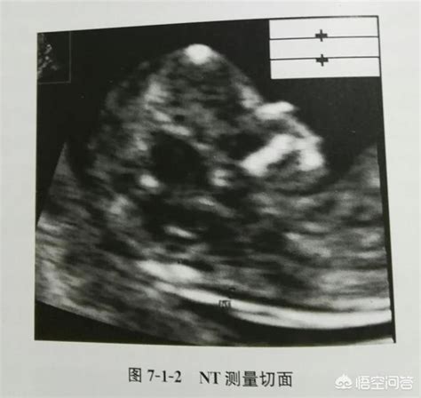 孕13周, 刚刚进入孕中期的胎宝宝, 现在大概发育成什么样了?|发育|胎宝宝|宝宝_新浪新闻