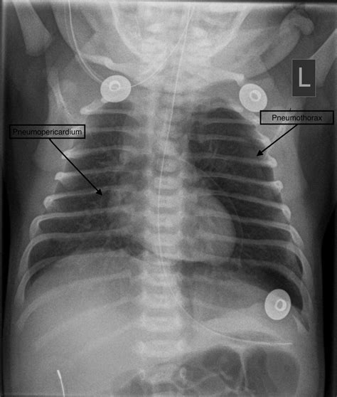 Term neonate with pneumopericardium, pneumothorax while on nasal ...