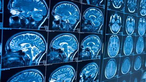 Is Parkinson’s disease, 'world’s fastest growing brain disease,’ mostly ...
