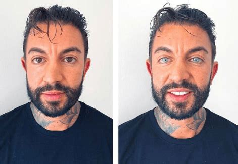 Image result for Eye Color Surgery