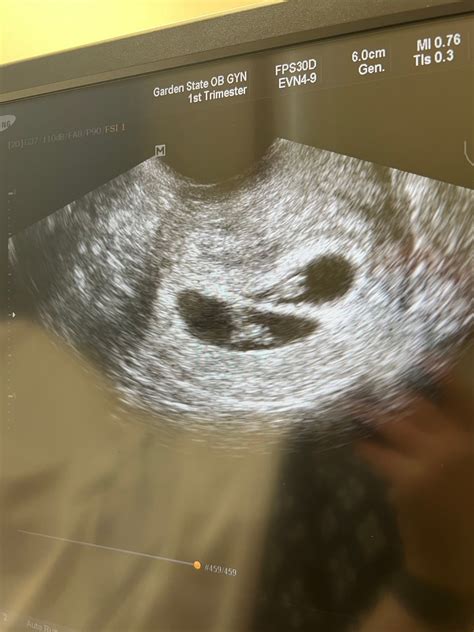 Seven week ultrasound - twins! | BabyCenter