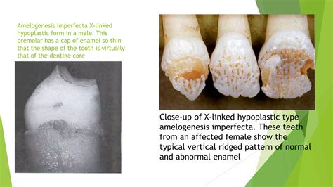 Amelogenesis imperfecta | PPTX