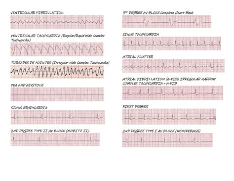 Free printable heart rhythm strips, Download Free printable heart ...