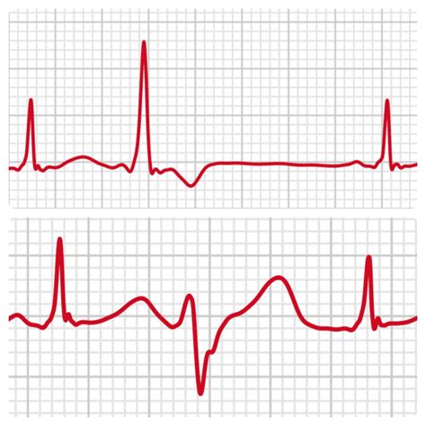 Pvc Pac During Exercise at Gayle Poston blog