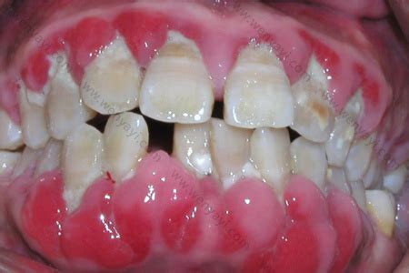 牙龈出血是什么原因 - 知乎