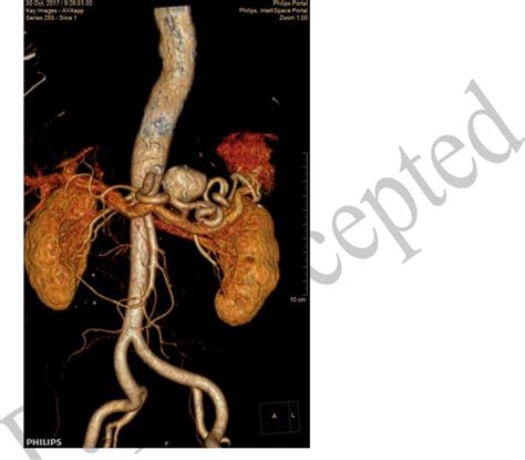 Figure 1 from Spleen-preserving surgical treatment of splenic artery ...